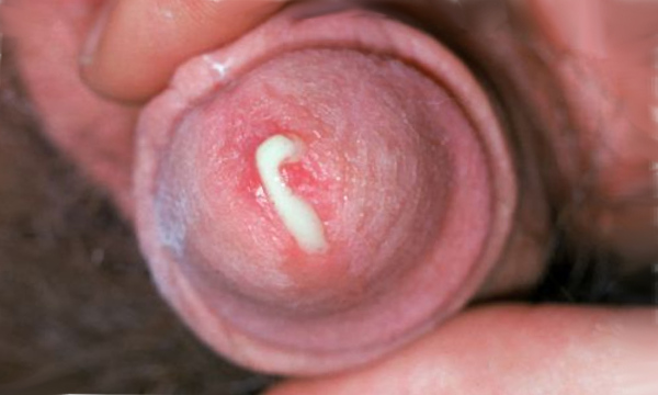 symptômes de la gonorrhée